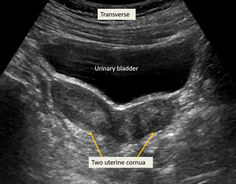 dating ultrasound bladder
